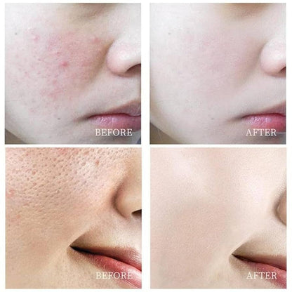 EXGYAN Salicylic Acid Shrink Pores Face Mask Oil Control Ance Treatment Sleeping Exfoliator Moisturising Oil Control Mask 120ml