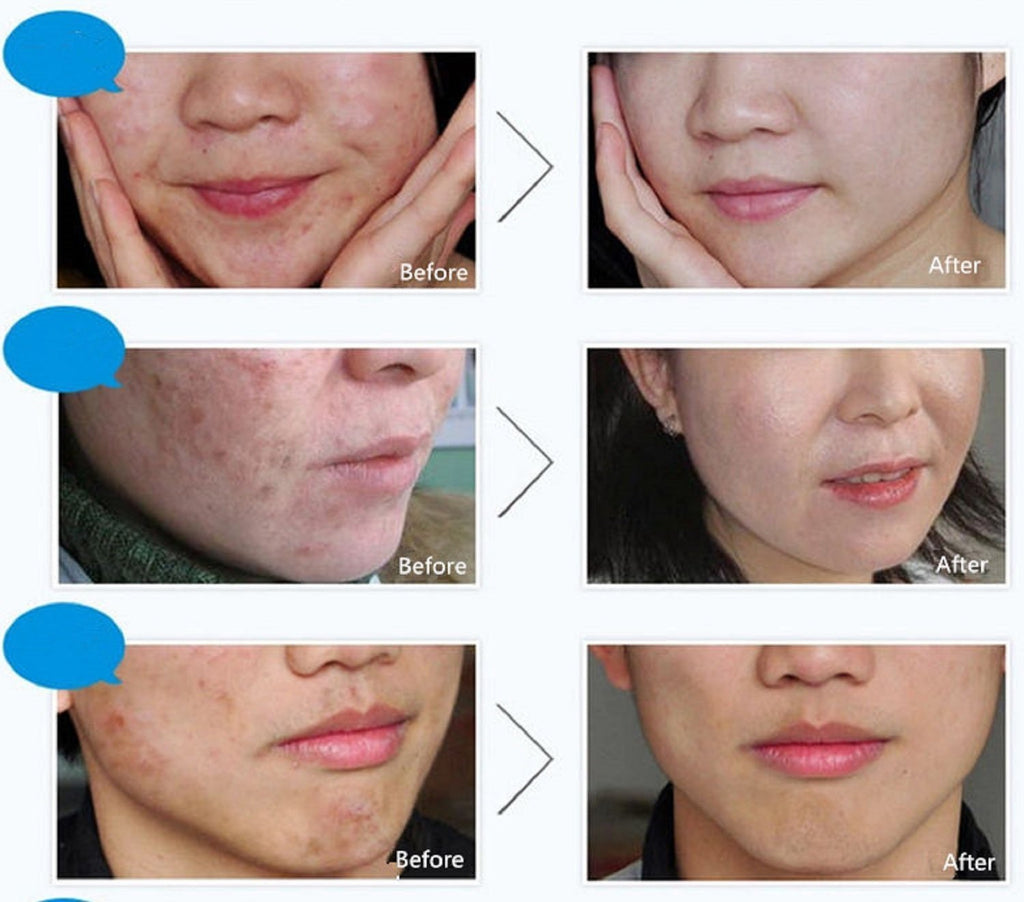 BIOAQUA Face Skin Care Acne Anti-Wrinkle Removal Cream Spots Scar Blemish Marks 30g