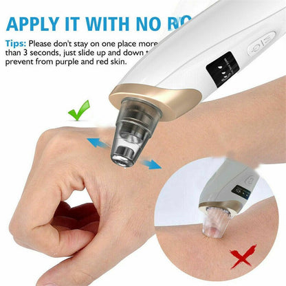 5 in 1 Rechargeable Digital Blackhead Remover