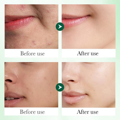 Sadoer Salicylic Acid Anti Acne Deep Nourish Repair Serum