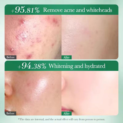 SADOER Salicylic Acid Niacinamide Tea Tree Acne Brightening Face Cream