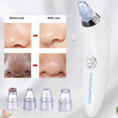Derma Suction Vacuum Blackheads And Facial Cleansing Device