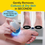 Pedi Vac Callus Remover